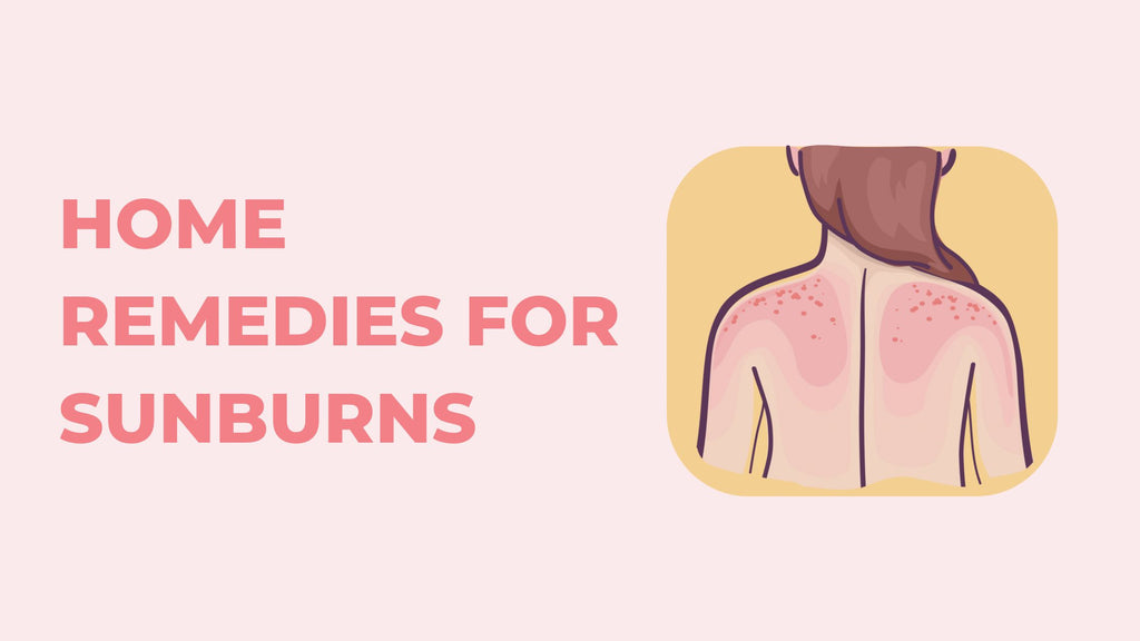 My Home Remedies For Treating Sunburns So They Heal Quickly And